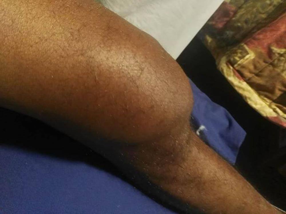 dark-skinned leg that is unnaturally swollen above the knee.
